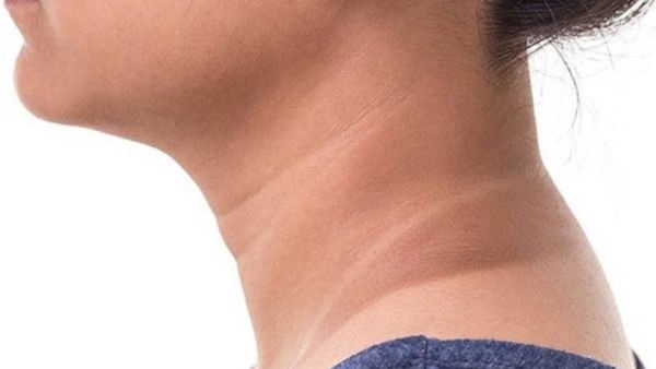 5 خطوات لتخلص من خطوط العنق