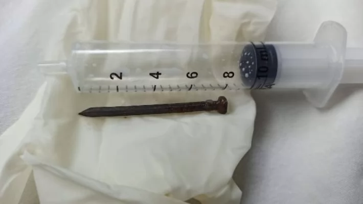 معهد الكبد بالمنوفية ينقذ طفلة تبلغ 7 سنوات ابتلعت مسمارًا طوله 4 سم