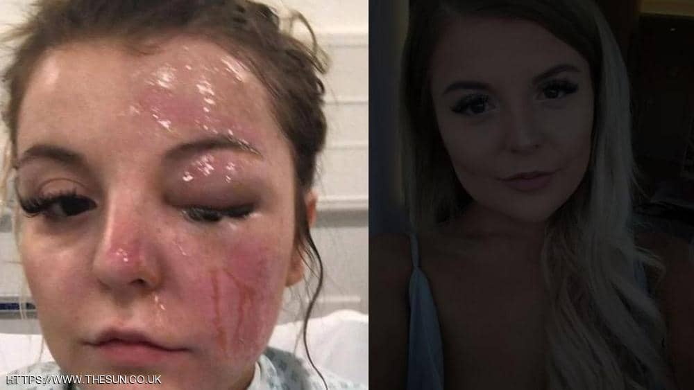 الميكروويف يتسبب فى فقد فتاة لإحدى عينيها