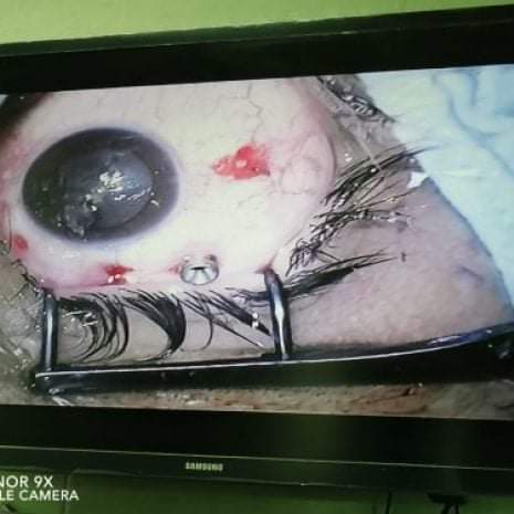  إنقاذ مصاب كورونا من فقدان البصر بعد إستخراج جسم زجاجى من عينه