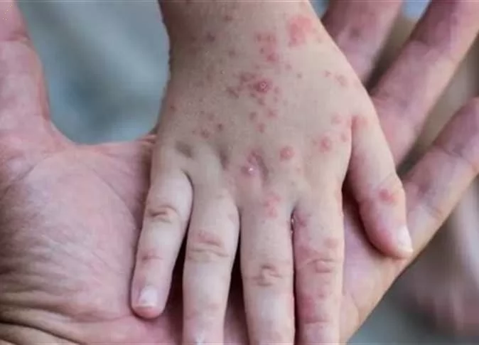 الذكاء الاصطناعي يرسم خريطة لقاح جديد لفيروس جدري القرود 