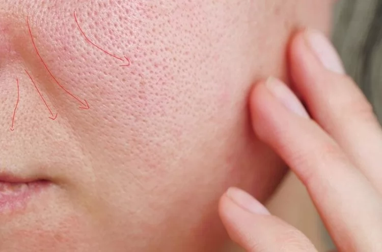 وصفات طبيعية لعلاج المسام الواسعة 