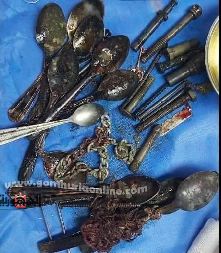 أربعيني يأكل الملاعق والمسامير..وطب جامعة المنوفية ينقذه من الموت