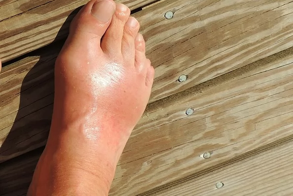 أطعمة تجنبها للوقاية من النقرس 