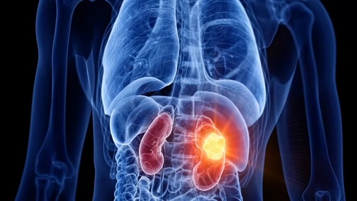 الذكاء الاصطناعي يدعم أطباء الأشعة في الكشف المبكر عن سرطان الكلى 