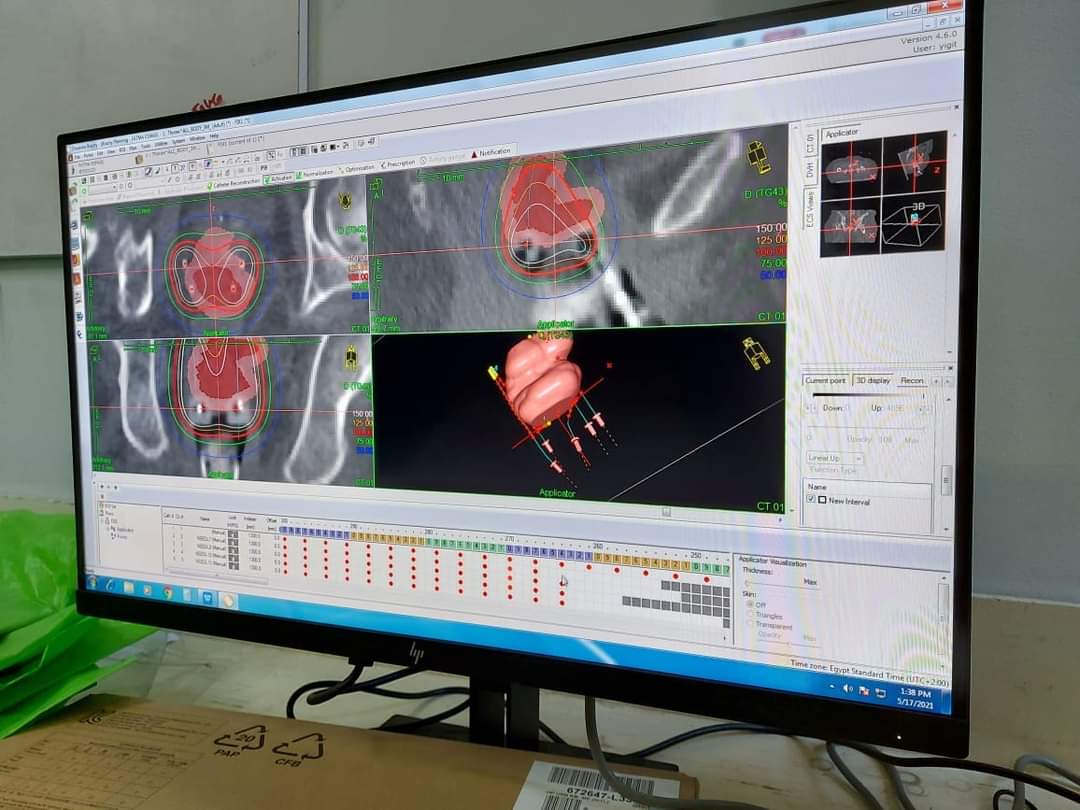  تقنية جديدة لعلاج أورام الرحم بإستخدام جهاز العلاج الإشعاعي عن قرب Brachytherapy