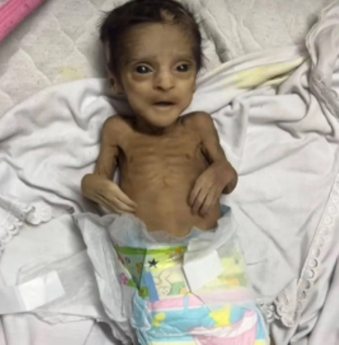 طفل يعاني من المجاعة في غزة