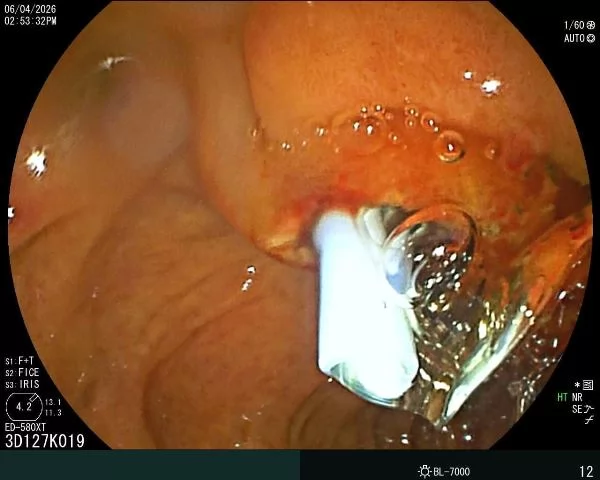لأول مرة بمحافظة البحر الأحمر:إجراء منظار القنوات المرارية (ERCP)