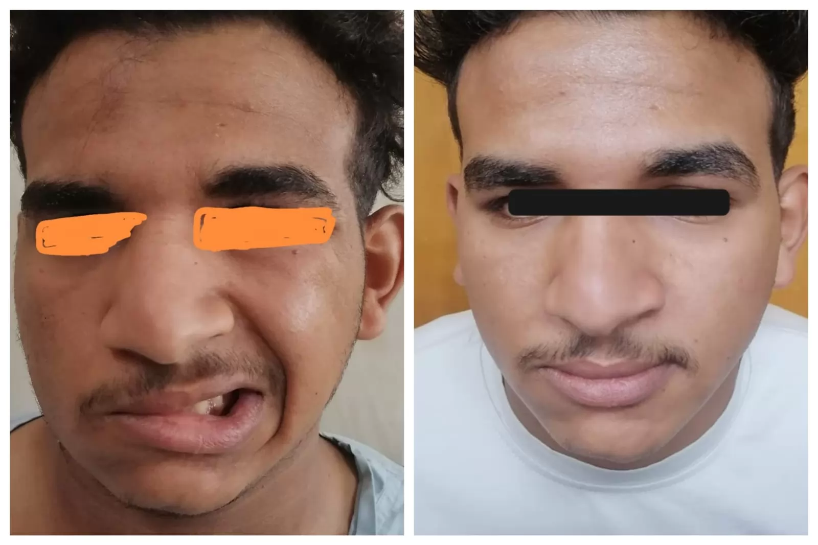 فريق طبي ينجح في استئصال ورم خبيث من الغدة لشاب عشريني