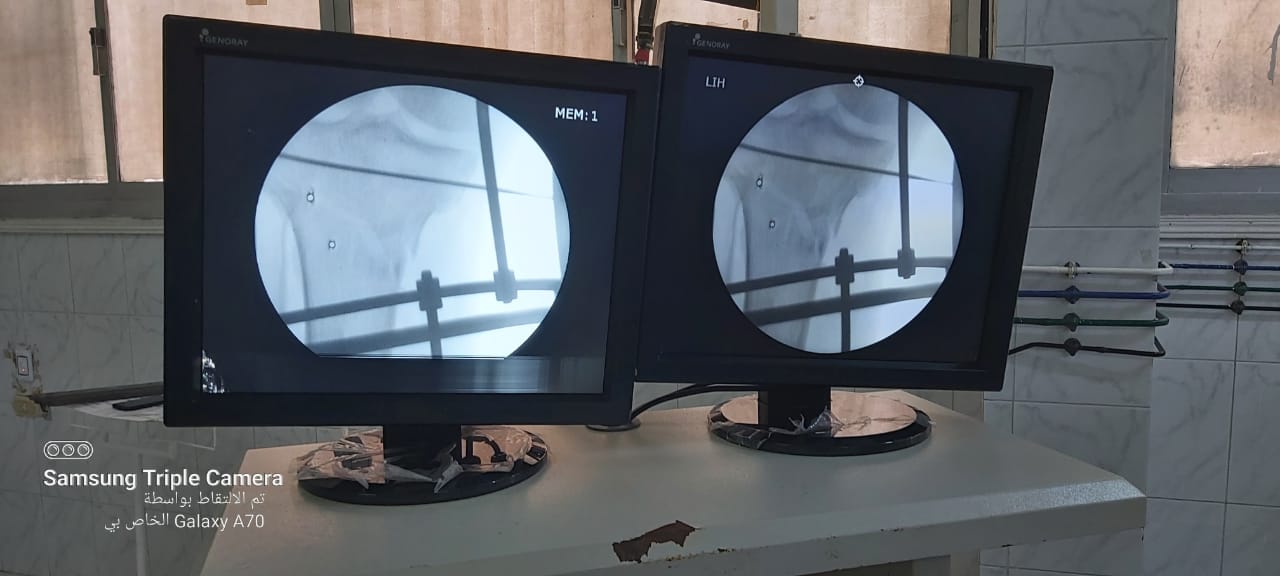 تركيب مفصل بالفخد بمنيا القمح وعملية تبيث عظام 