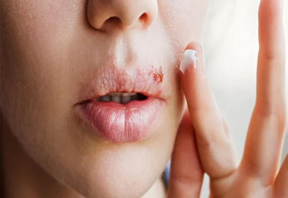 قرحات البرد الجلدية .. الأسباب والأعراض وطرق العلاج الحديثة 