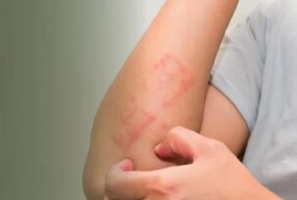 نيموليزوماب.. علاج بيولوجي واعد لتخفيف الحكة السريعة لدى مرضى الإكزيما 