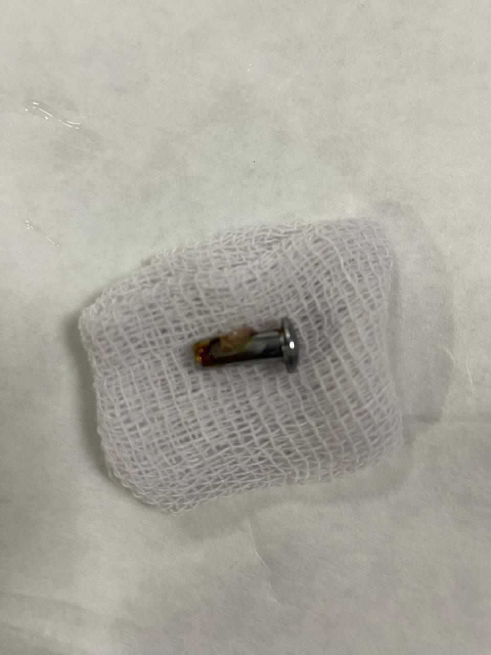 إنقاذ حياه طفله ابتلعت مسمار إستقر بالرئه في مستشفي الأطفال ببنها