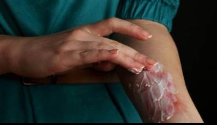 الاسعافات الأولية للحروق بقلم : الدكتورة ابتسام على