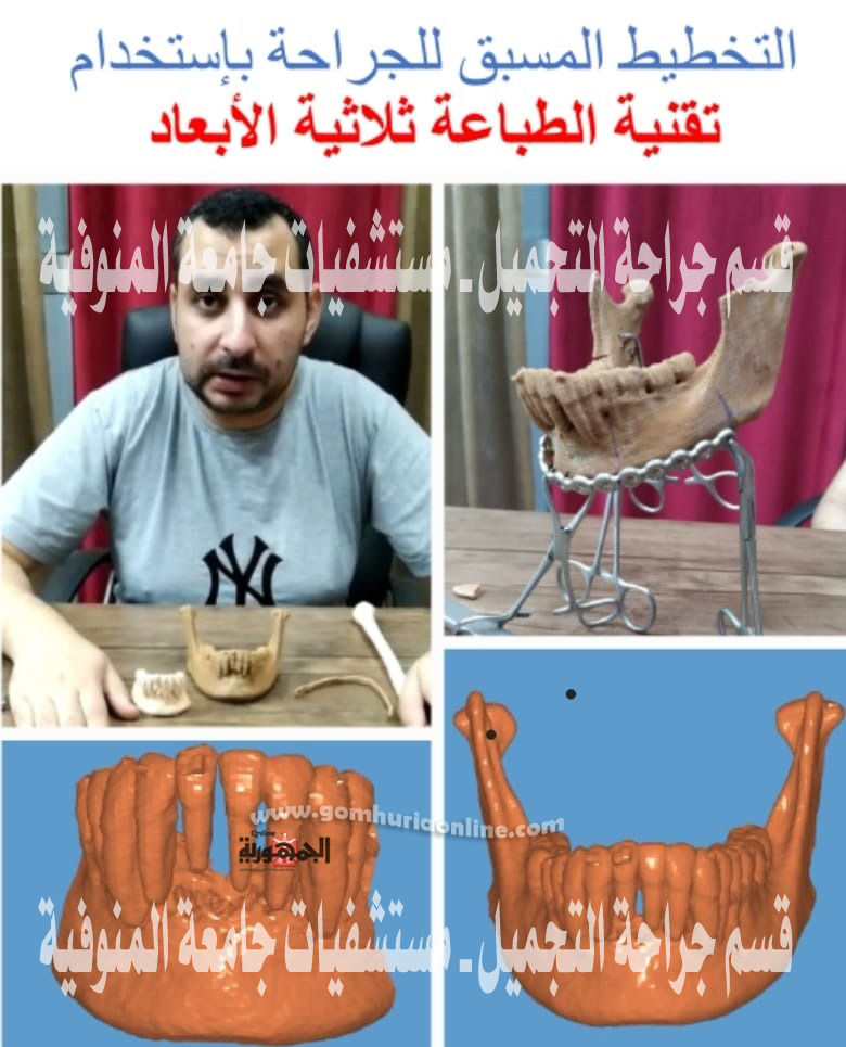 نجاح أول حالة إعادة بناء للفك بعد إستئصاله جراحيا لوجود ورم خبيث بمستشفيات جامعة المنوفية