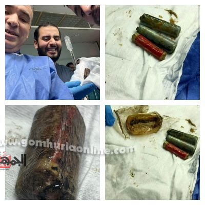 معجزة طبية بالمنوفية: استخراج حجارة ريموت من معدة مريض بدون جراحة