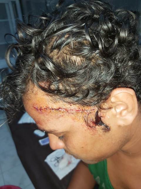 ثمن الشهامة ١٧ غرزة .شاب بالغردقة أنقذ فتاة من تحرش البلطجية فشوهو وجهه بالمطاوي.صور