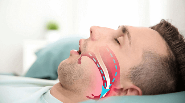 انقطاع التنفس أثناء النوم