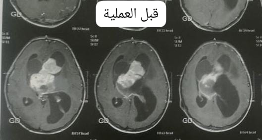 First slide
