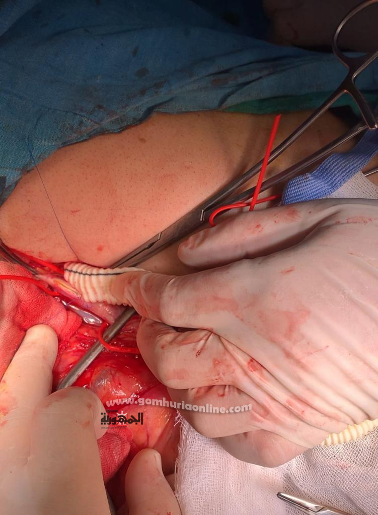 لاول مره ببنى سويف: جراحة 5ساعات لتوصيل بالشريان الاورطي بالمستشفى التخصصي