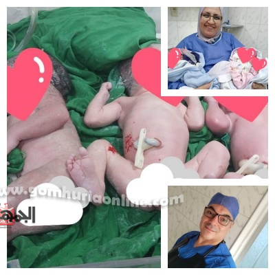 نجاح ولادة 3 توائم بمستشفى قويسنا المركزي بالمنوفية