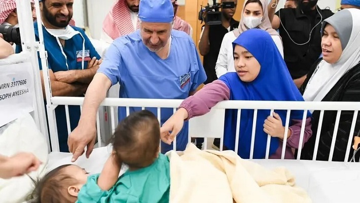 التوأم الفلبيني الملتصق