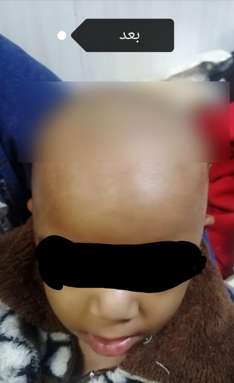 جراحة دقيقة بمخ طفل تنقذه من فقدان البصر بمستشفى سوهاج الجامعي