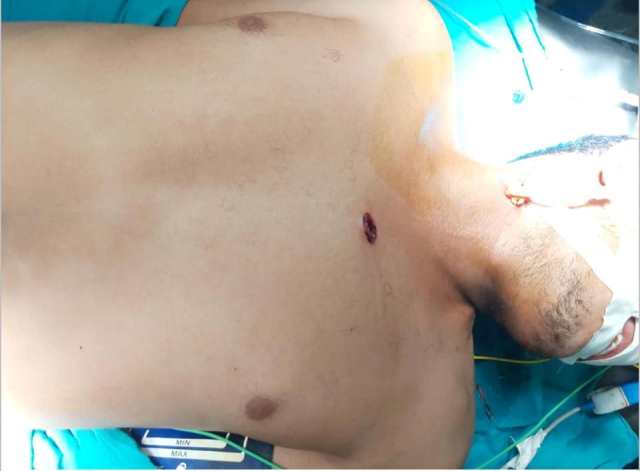 مستشفي سوهاج الجامعي تنقذ شاباً من الموت