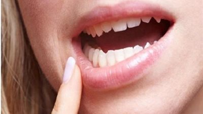 متها الشعور بالخدر .. علامات الإصابة بسرطان الغشاء المخاطي للفم
