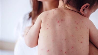 6 نصائح مهمة لحماية أسرتك من وباء الجديري المائي