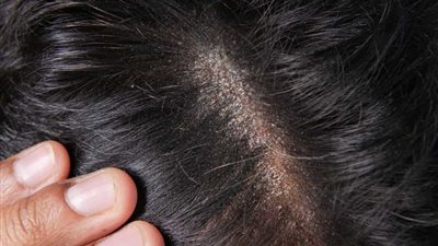 7 خطوات للتخلص من فطريات الشعر..تعرف عليها