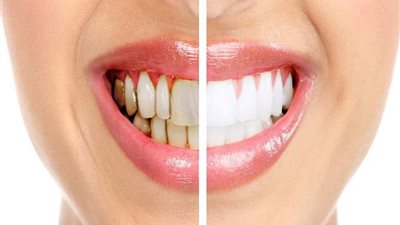 علاجات منزلية تحمى اسنانك من التسوس