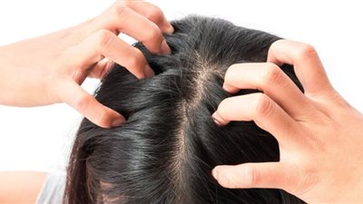 نصائح للتخلص من قشرة الرأس