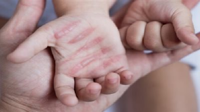 الصحة تحذر من استخدام بعض المواد أثناء التعامل مع الحروق