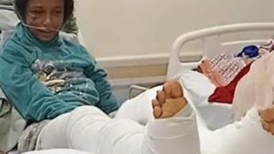 إصابة طفلة بكسر مضاعف إثر سقوط عمود إنارة عليها
