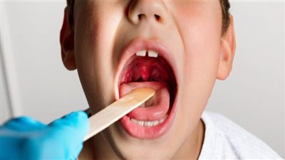 تعرف على فائدة تناول الثوم في علاج التهاب اللوزتين