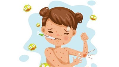 أعراض واضحة للإصابة بمرض الحصبة..لا تتجاهلها
