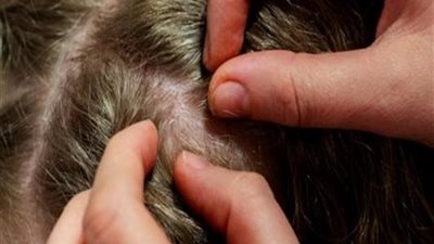 5 نصائح للتخلص من قمل الرأس..تعرف عليها