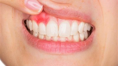 استخدامات خل التفاح لعلاج التهاب اللثة..تعرف عليها