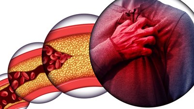 خطة من 3 مراحل للتحلص من الكولسترول الضار..تعرف عليها