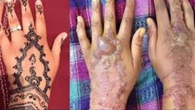 تسبب الوفاة ..مركز سموم الإسكندرية يحذر من استخدام الحنة السوداء