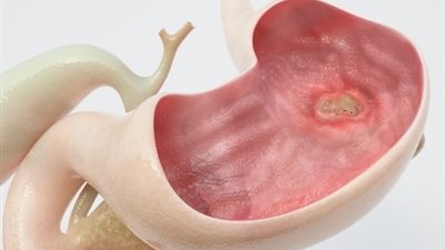 قرحة المعدة واعراضها..تعرف عليها