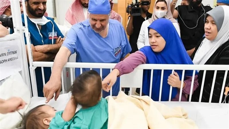 التوأم الفلبيني الملتصق