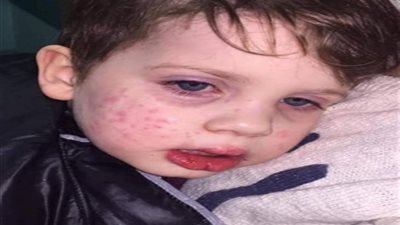 قبلة تصيب طفل بمرض جلدي خطير