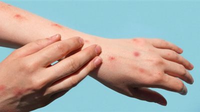 رومانيا تسجل 503 إصابات جديدة بالحصبة خلال أسبوع