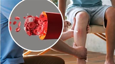 علامات وأعراض تدل على الإصابة بجلطة دموية
