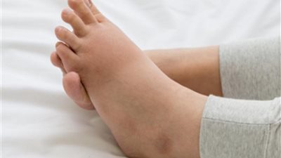 أسباب الإصابة بتورم الكاحلين