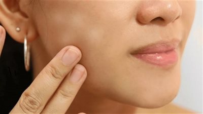 تعرف على الفرق بين البقع البيضاء والبهاق