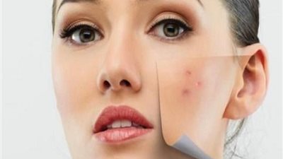 أنواع بثور الوجه