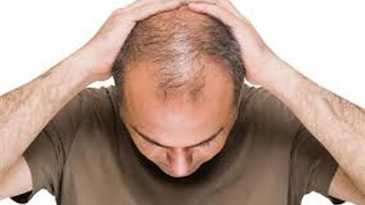 باستخدام السكر..علاج جديد للصلع وتساقط الشعر